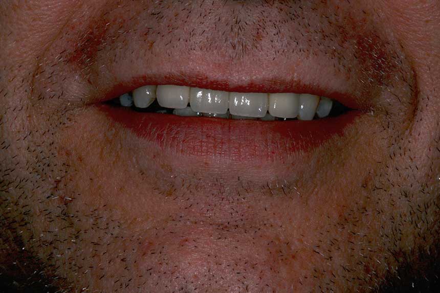 Tooth implant example 2 - after