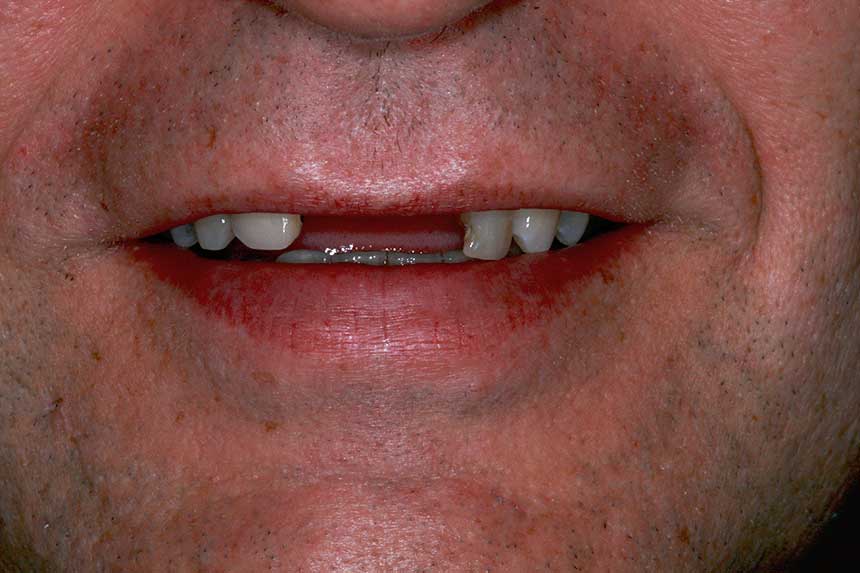 Tooth implant example 2 - before