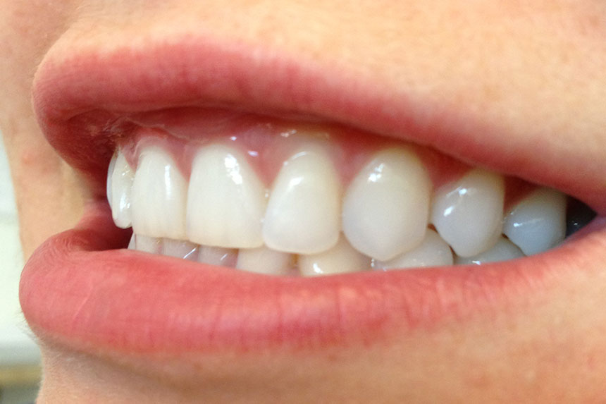 Inman aligner example 1 after