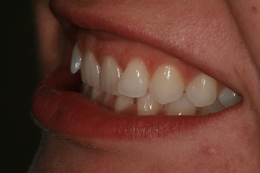 Inman aligner example 1 before
