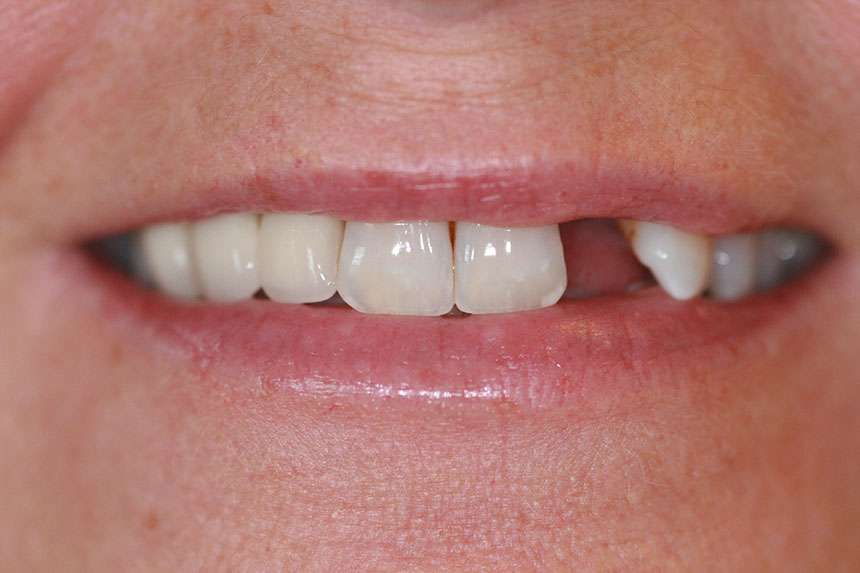 dental implants example 3 before version 2