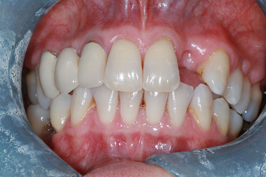 dental implants example 3 before