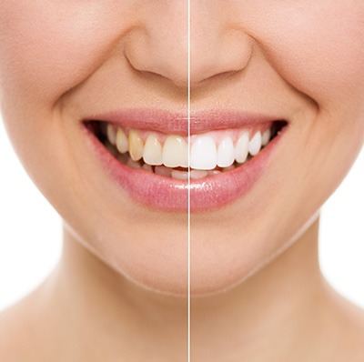 Tooth whitening Oldham